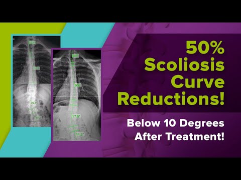 50% Scoliosis Curve Reductions! Below 10 Degrees After Treatment!