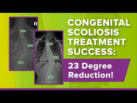 Congenital Scoliosis Treatment Success: 23 Degree Reduction!