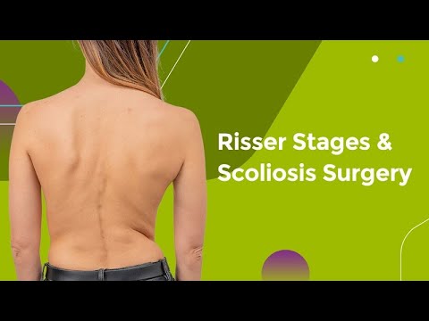 Risser Stages &amp; Scoliosis Surgery