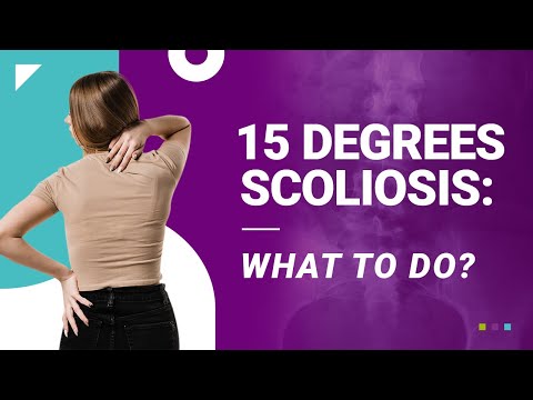 15 Degrees Scoliosis: What To Do?
