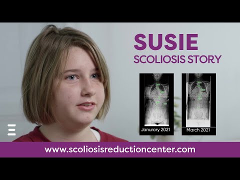 Adolescent Conservative Scoliosis Treatment Without Surgery, Susie&#039;s Story