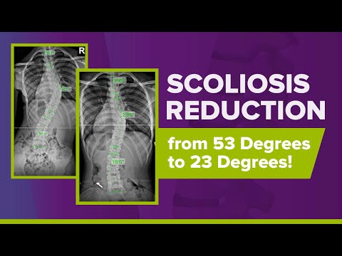 Scoliosis Reduction from 53 Degrees to 23 Degrees: Ronica&#039;s Story
