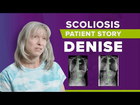 Adult Scoliosis Treatment Without Surgery: Denise&#039;s Story