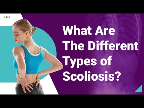 What Are The Different Types of Scoliosis?