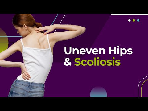 Uneven Hips and Scoliosis