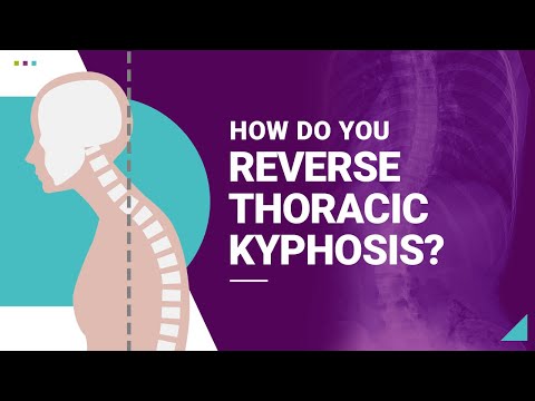 How Do You Reverse Thoracic Kyphosis?