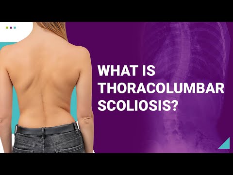 What is Thoracolumbar Scoliosis?