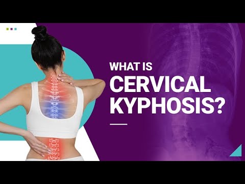 What is Cervical Kyphosis?