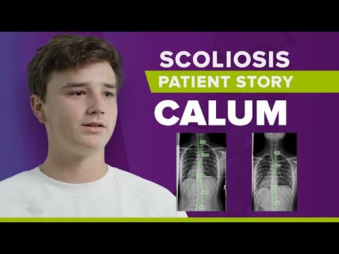 Scoliosis Pain Reduction Success: Calum&#039;s Story