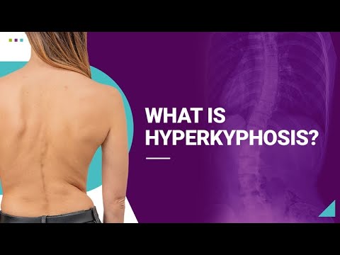 What is Hyperkyphosis?