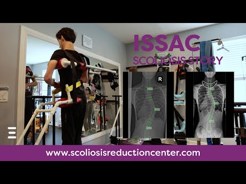 Adolescent Scoliosis Treatment Without Surgery Patient Story, Issac