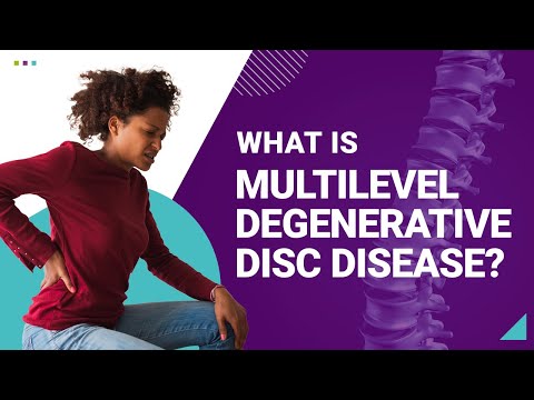 What is Multilevel Degenerative Disc Disease?