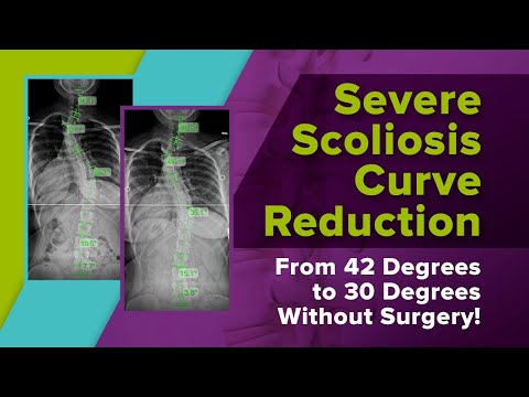 Severe Scoliosis Curve Reduction From 42 Degrees to 30 Degrees Without Surgery!