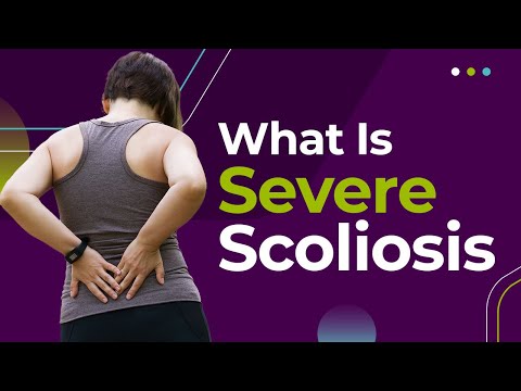 What Is Severe Scoliosis?
