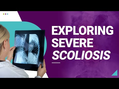Exploring Severe Scoliosis