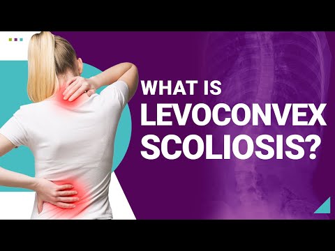 What is Levoconvex Scoliosis?