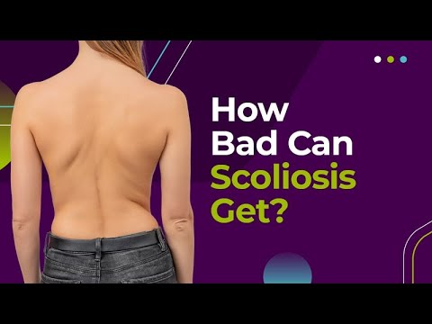 How Bad Can Scoliosis Get?