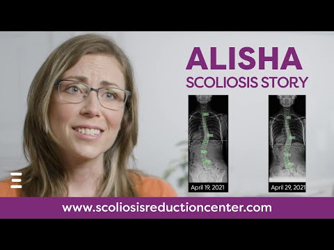 Adult Scoliosis Alternative Treatment Without Surgery, Alisha&#039;s Story