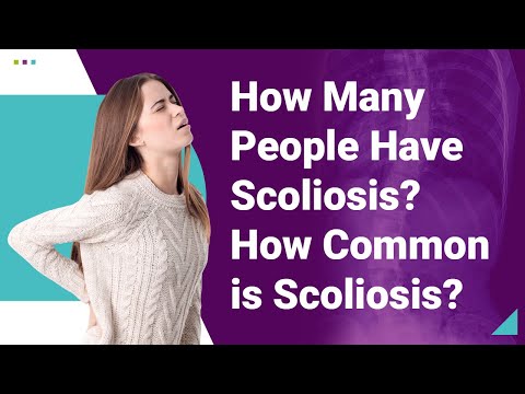 How Many People Have Scoliosis? How Common is Scoliosis?