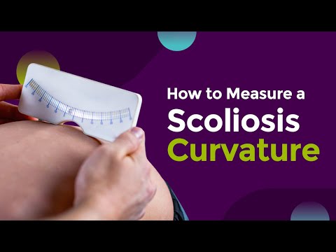 How to Measure a Scoliosis Curvature
