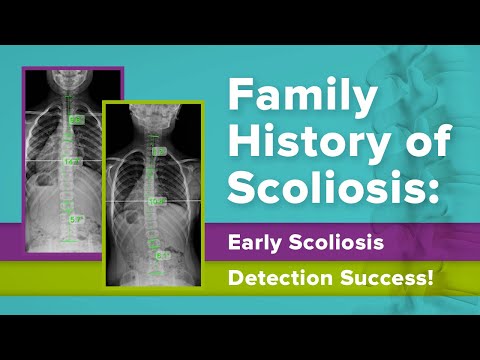 Family History of Scoliosis: Early Scoliosis Detection Success!