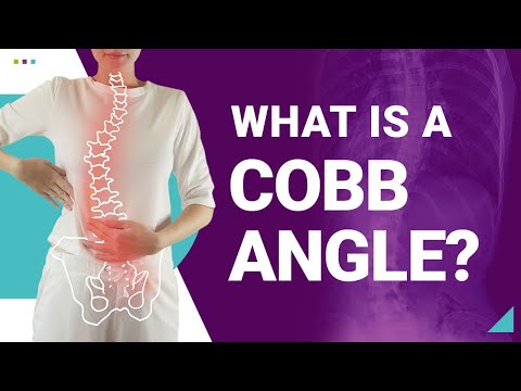 How Does a Cobb Angle Classify Scoliosis?
