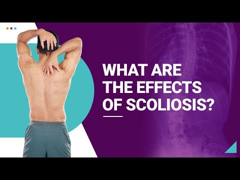 What are the Effects of Scoliosis?