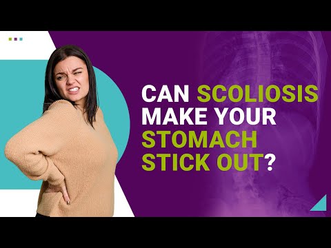 Can Scoliosis Make Your Stomach Stick Out?