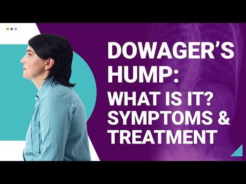Dowager&#039;s Hump: What is it? Symptoms &amp; Treatment