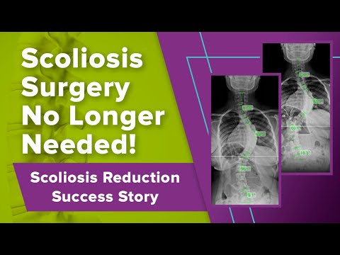 Scoliosis Surgery No Longer Needed! Scoliosis Reduction Success Story
