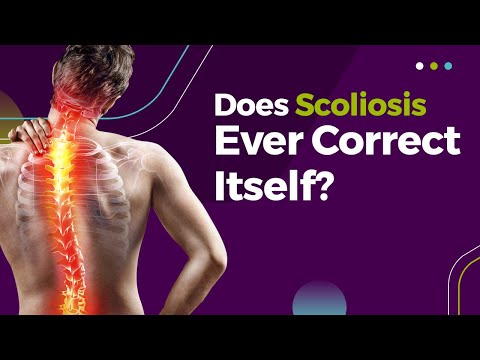 Does Scoliosis Ever Correct Itself?