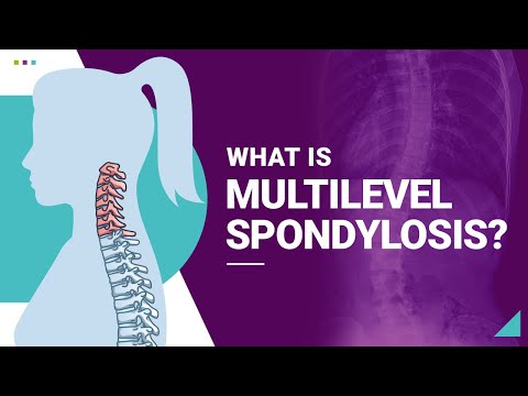 What is Multilevel Spondylosis?