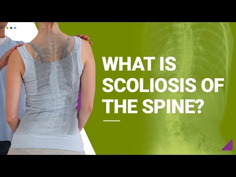 What is Scoliosis of the Spine?