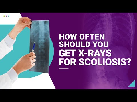 How Often Should You Get X-rays for Scoliosis?