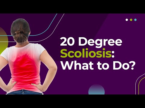 20 Degree Scoliosis: What to Do?