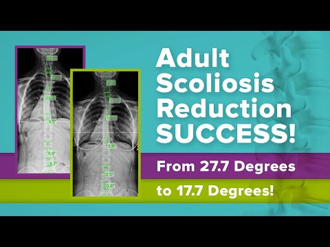 Adult Scoliosis Reduction SUCCESS! From 27.7 Degrees to 17.7 Degrees! (Amber&#039;s Story)