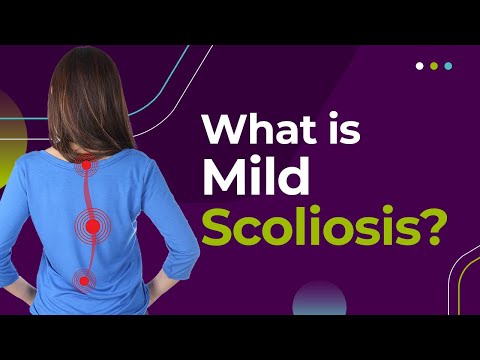 What is Mild Scoliosis?