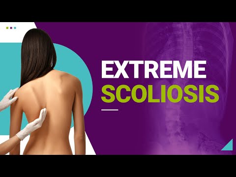 Extreme Scoliosis