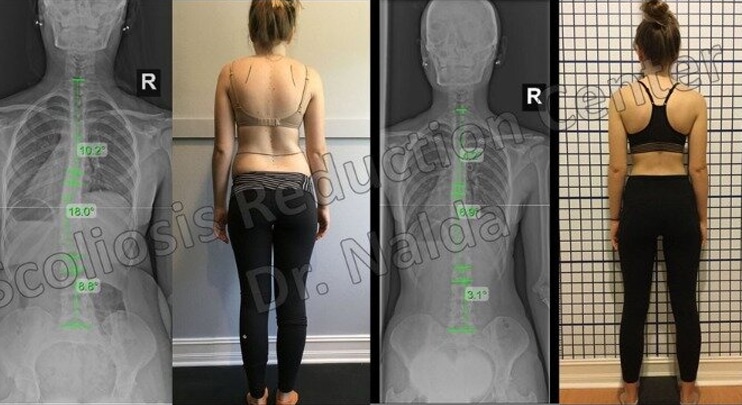 Before and After Scoliosis Treatment 1
