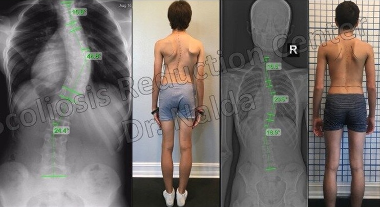 Before and After Scoliosis Treatment 2