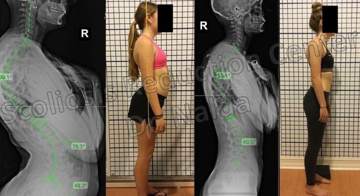 Before and After Scoliosis Treatment 3