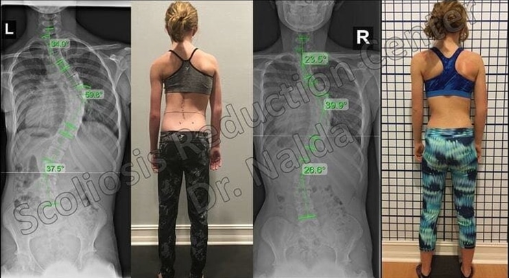 Before and After Scoliosis Treatment 4