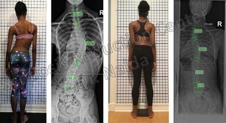 Dr. Tony Nalda before after scoliosis treatment