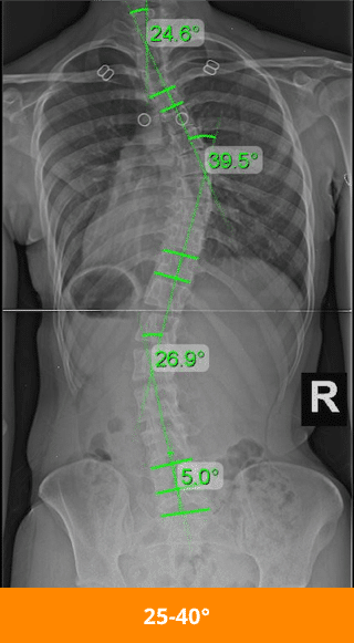 moderate scoliosis