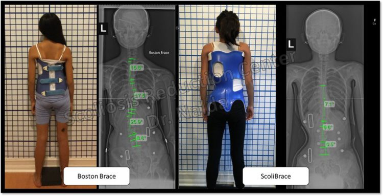 What is the Scoliosis Traction Chair?