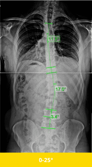 Mild Scoliosis