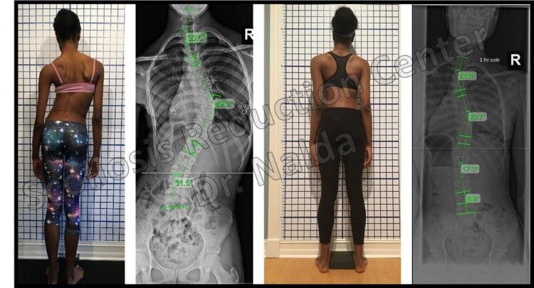 Pre Post Scoliosis Treatment X-Ray