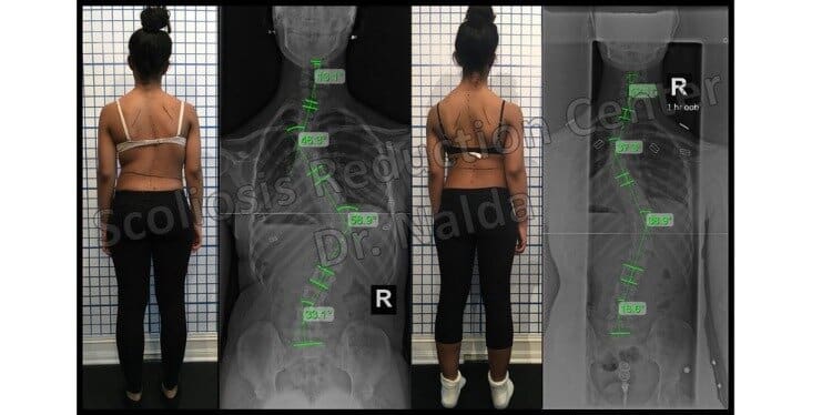 Pre Post Scoliosis Treatment X-Ray