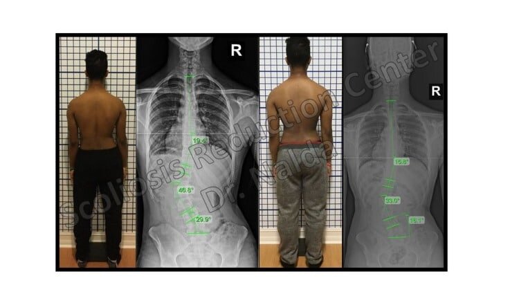 Pre Post Scoliosis Treatment X-Ray