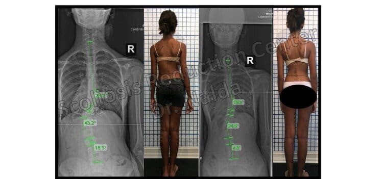 Pre Post Scoliosis Treatment X-Ray